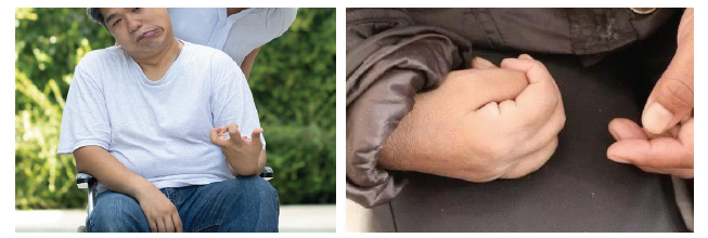 Post-stroke hand deformity images